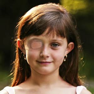 علائم تنبلی چشم در کودکان