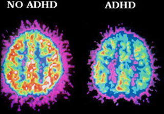  مغز ADHDدر مقابل مغز غیر ADHD