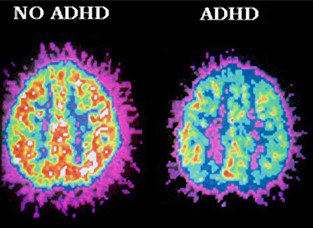 مغز ADHDدر مقابل مغز غیر ADHD