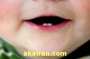  آبسه دندان،یکی از بیماری های شایع در کودکان