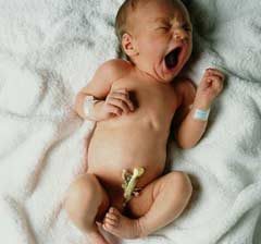  مراقبت از بند ناف در نوزاد تازه متولد شده